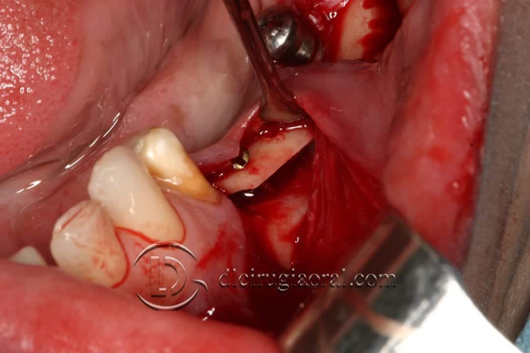 implantes sobre reconstrucción mandibular