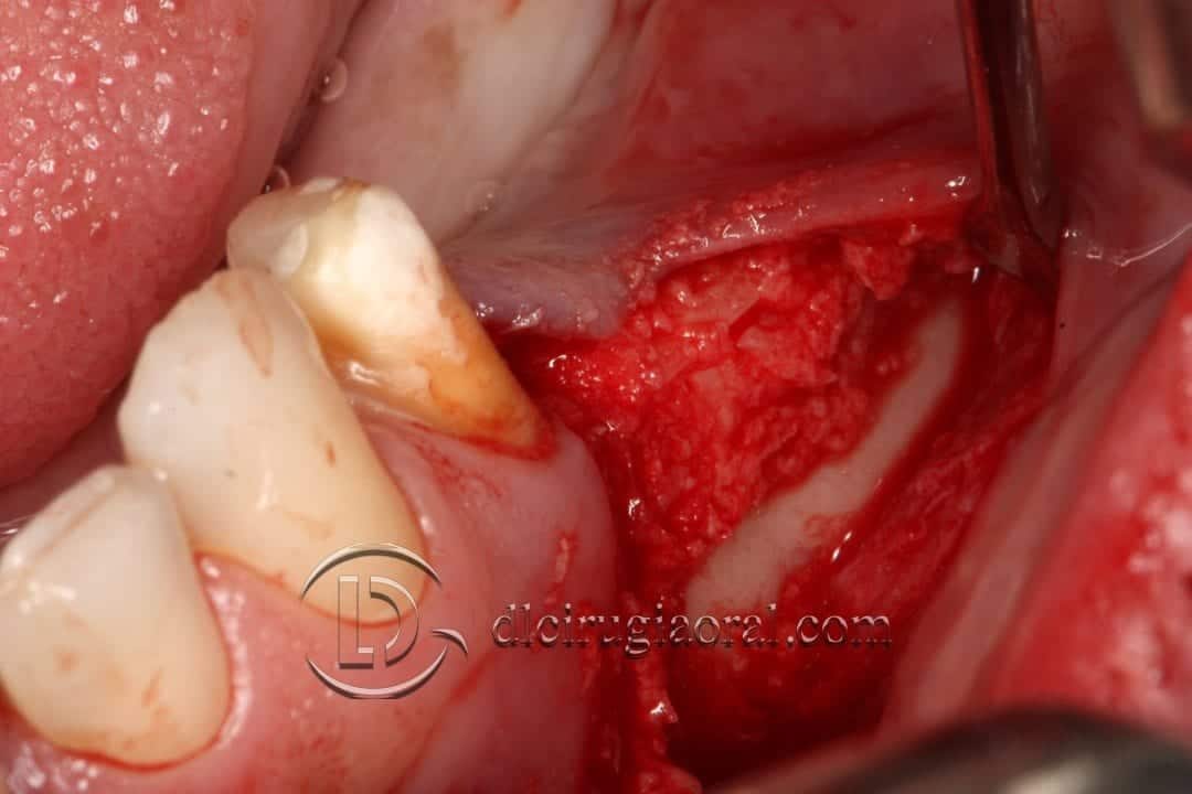 implantes sobre reconstrucción mandibular