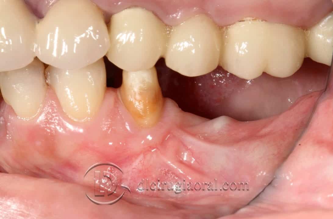 implantes sobre reconstrucción mandibular