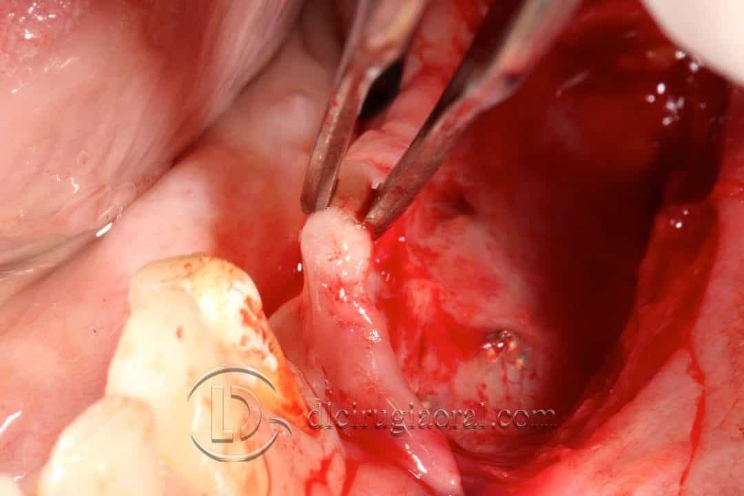 implantes sobre reconstrucción mandibular