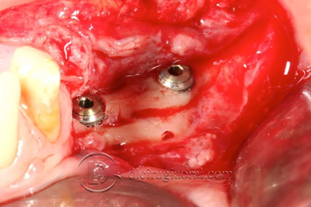 implantes sobre reconstrucción mandibular