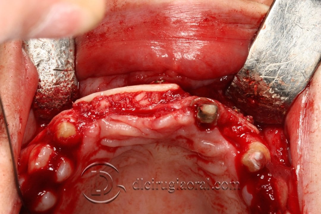 colocación de implantes en sector anterior