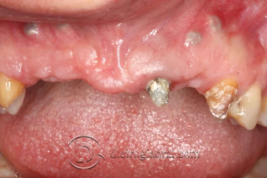Reconstrucción Ósea con Tecnica de Khoury