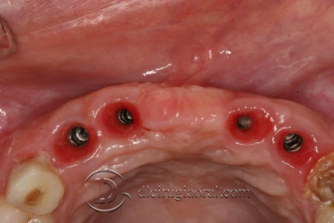 colocación de implantes en sector anterior