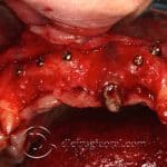 colocación de implantes en sector anterior