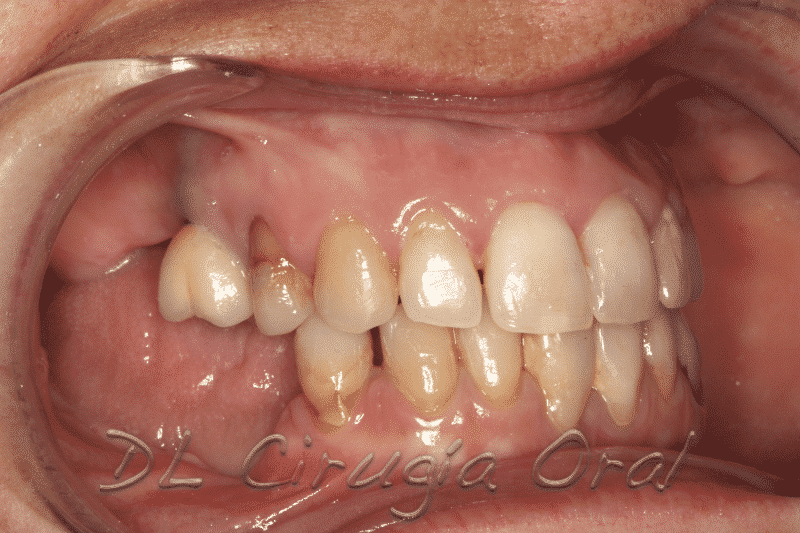 Reconstrucción mandibular posterior