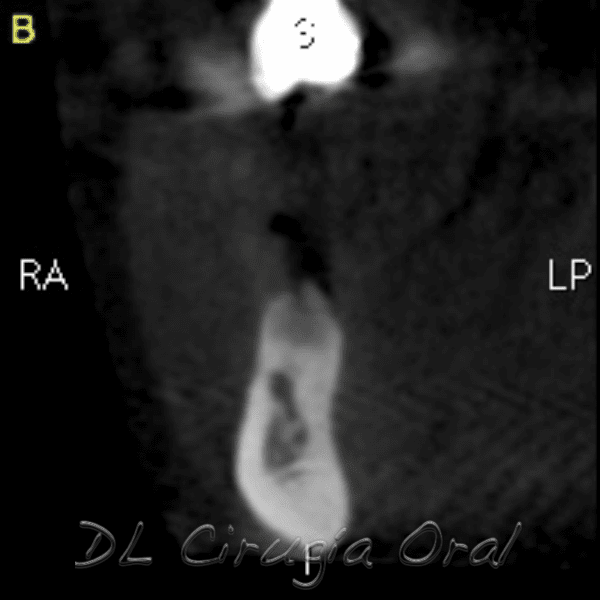 Reconstrucción mandibular posterior