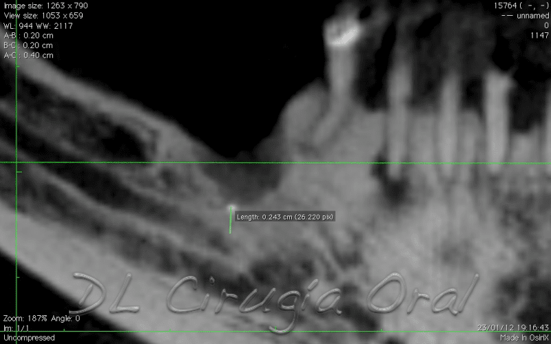 Reconstrucción mandibular posterior atrófica