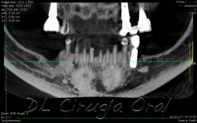 Reconstrucción mandibular posterior