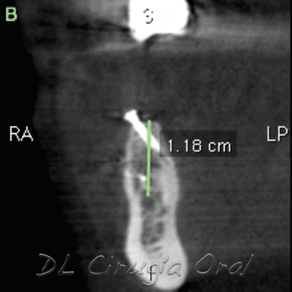 Reconstrucción mandibular posterior