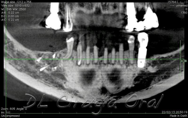 Reconstrucción mandibular posterior
