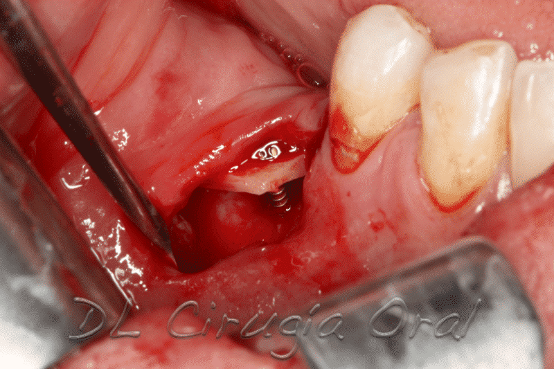 Reconstrucción mandibular posterior
