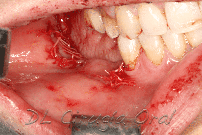 Reconstrucción mandibular posterior