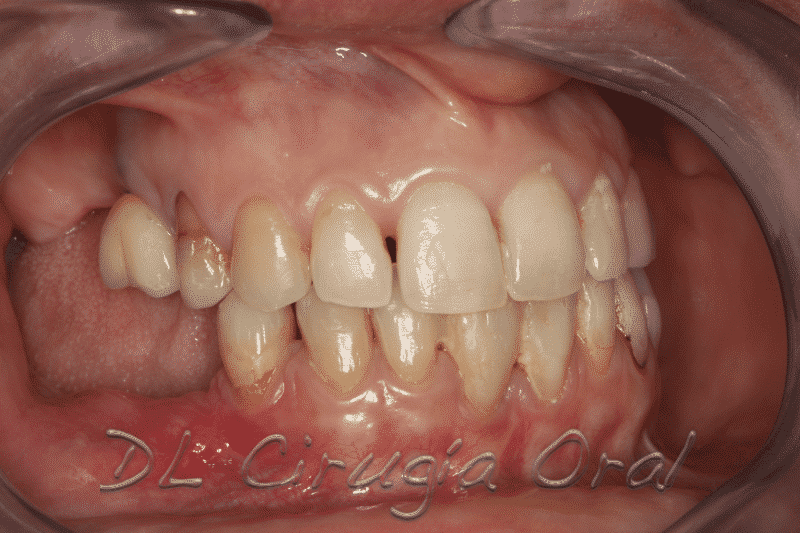 Reconstrucción mandibular posterior