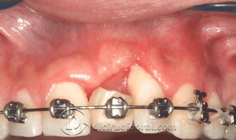 Pérdida de Implante Dental