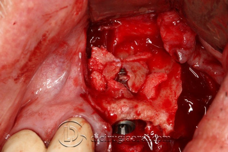 Elevación sinusal y reconstrucción posterior