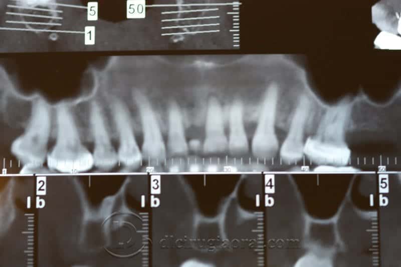 Regeneración ósea horizontal zona estética: Atrofia en incisivo central