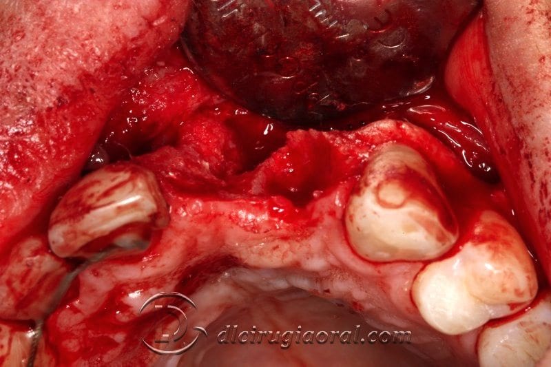 Defecto vista oclusal