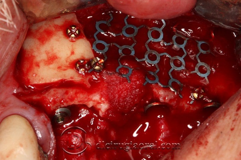 Cirugía de implantes compleja: Bloque + Regeneración + Elevación de Seno