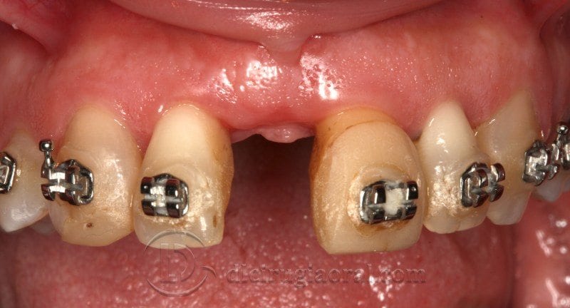 Regeneración ósea horizontal zona estética: Atrofia en incisivo central
