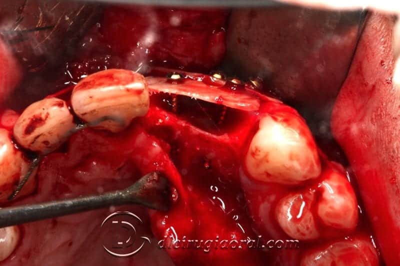 Reconstrucción vista oclusal