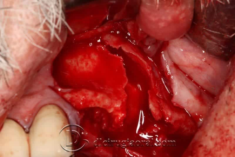 cirugía de implantes compleja