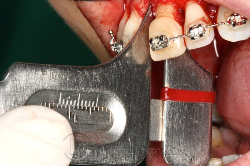 Regeneración ósea horizontal zona estética: Atrofia en incisivo central