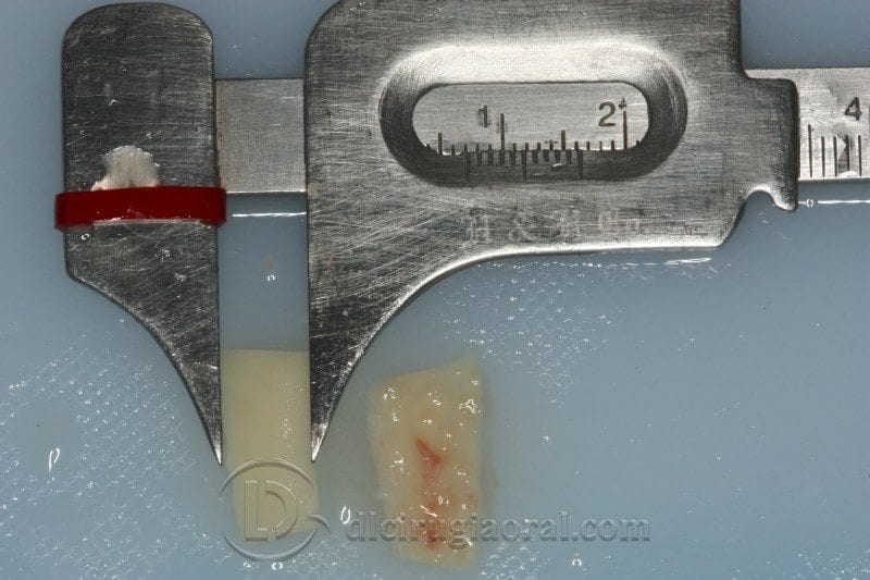 Regeneración ósea horizontal zona estética: Atrofia en incisivo central