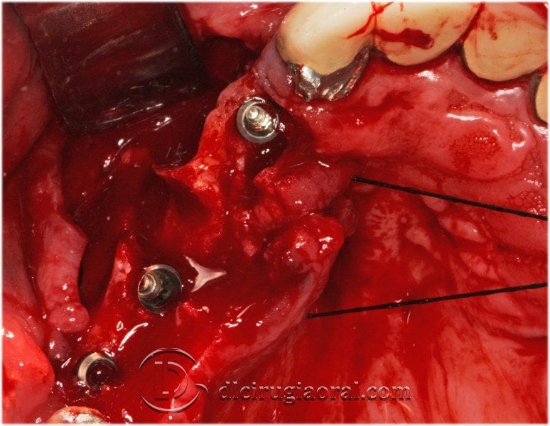 Cirugía oral con varias técnicas