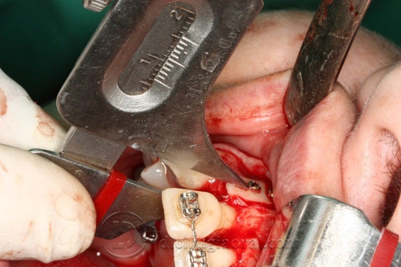 Regeneración ósea horizontal zona estética: Atrofia en incisivo central
