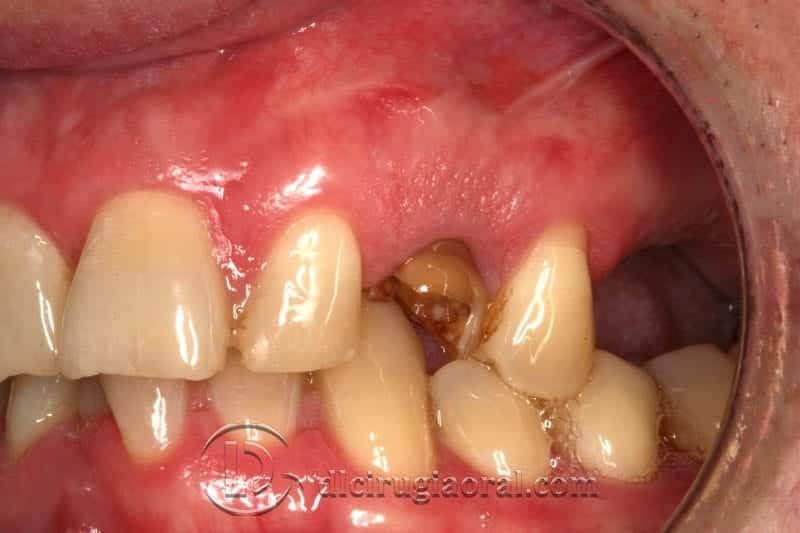 Exodoncia canino