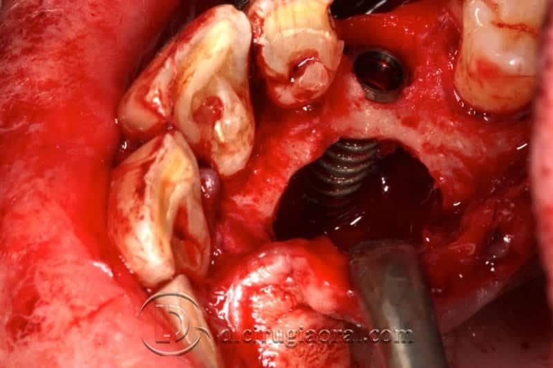 implante de canino dental