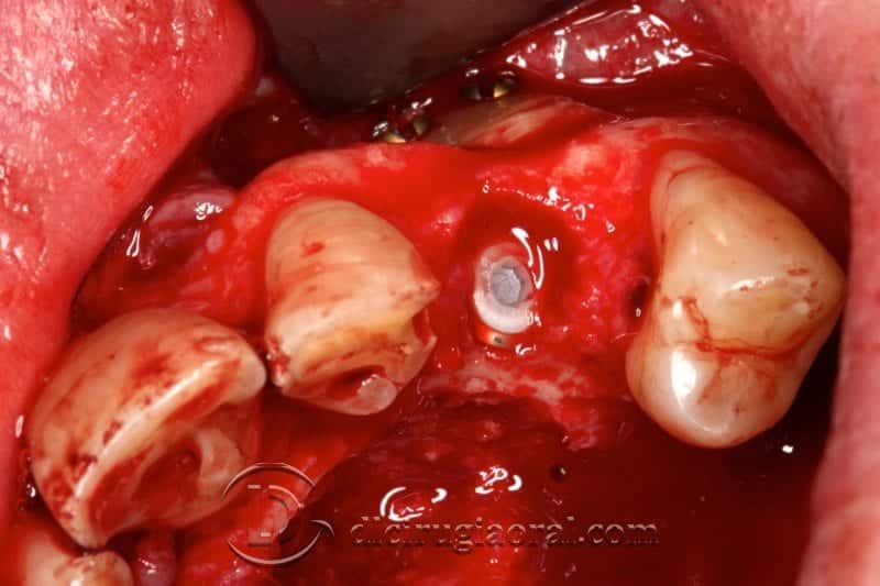 implantología canino dental