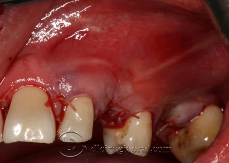 implantología canino dental
