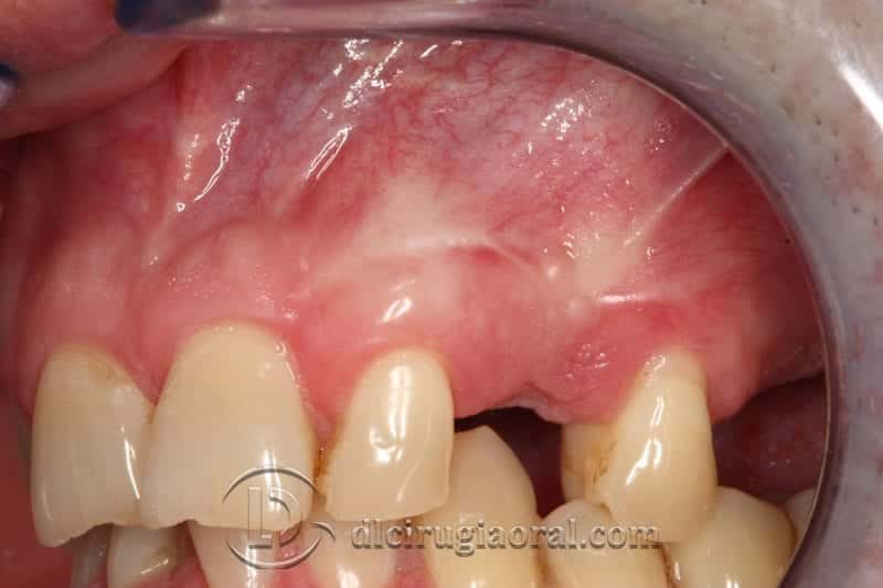 implantología canino dental