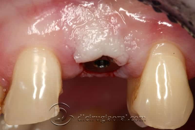 implantología canino dental