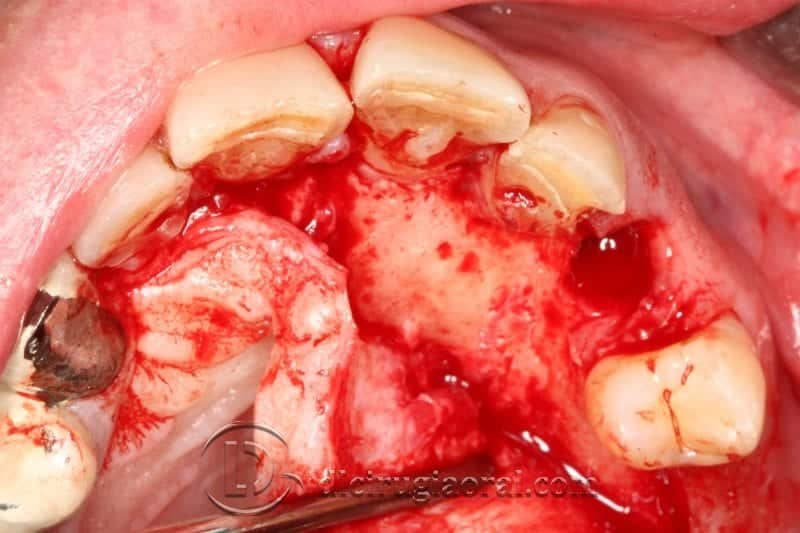 caso de regeneración canino dental