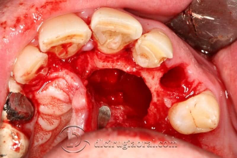 caso de regeneración canino dental
