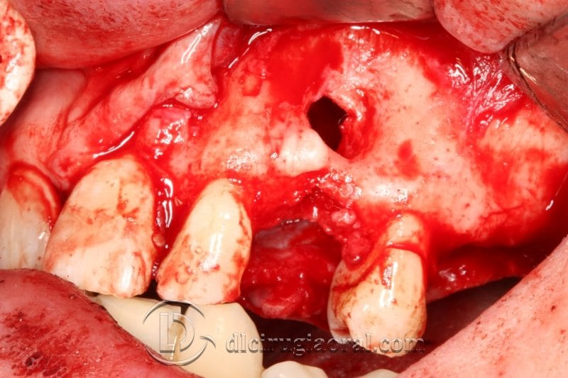 caso de regeneración canino dental
