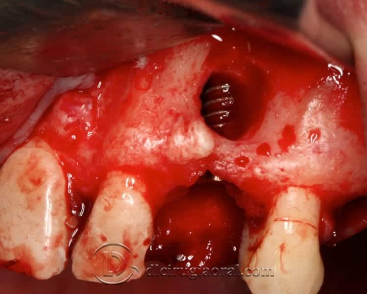 implante de canino dental