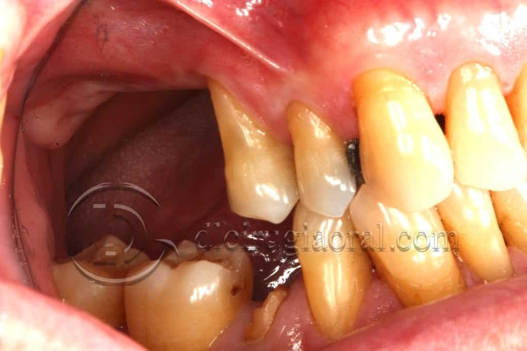 curso sobre reconstrucción maxilar