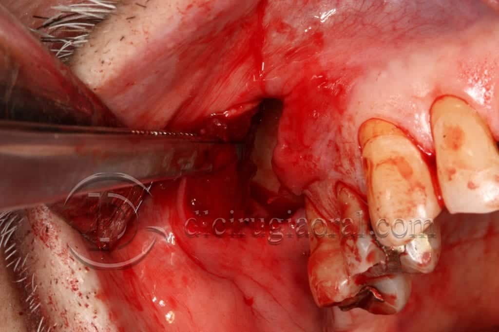 curso sobre reconstrucción maxilar