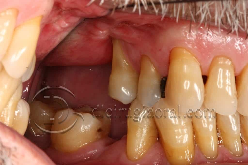 curso sobre reconstrucción maxilar