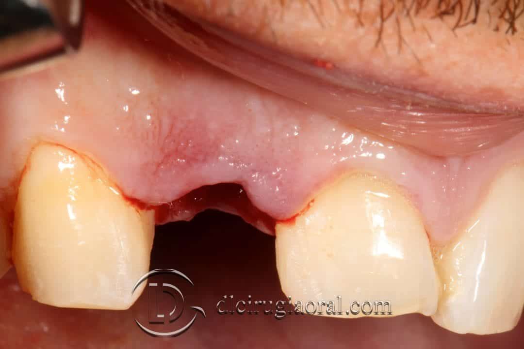 implante inmediato margen gingival