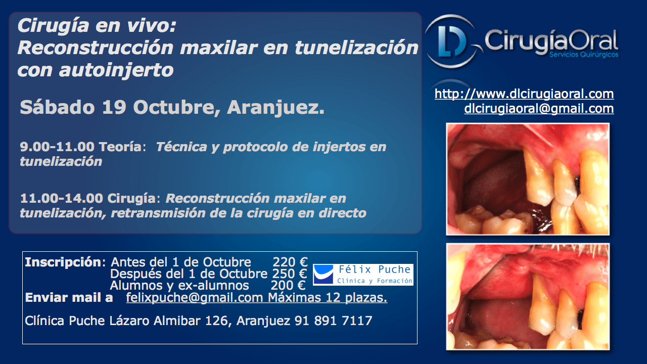 Curso sobre reconstrucción maxilar en tunelización – 19 de octubre