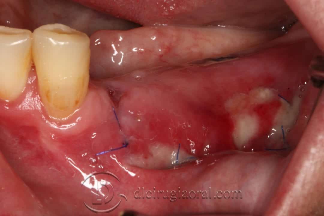 Vestibuloplastia de Kazanjian
