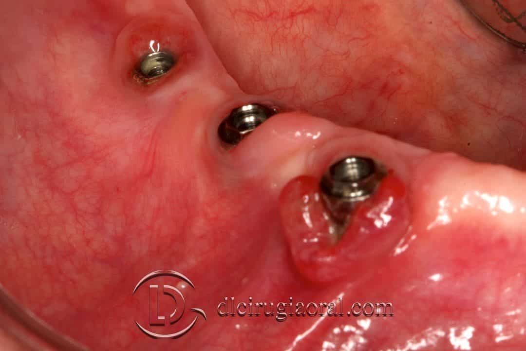 Injerto libre epitelial en periimplantitis mucositis