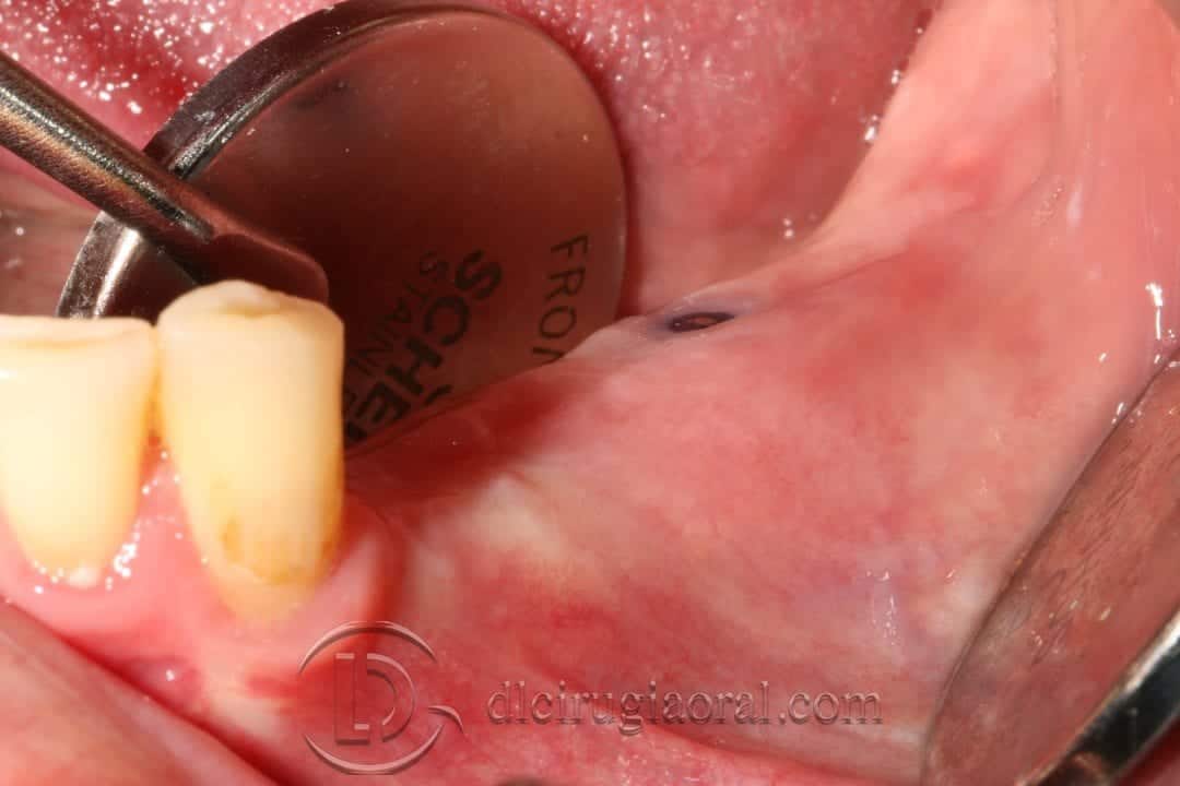 Vestibuloplastia de Kazanjian