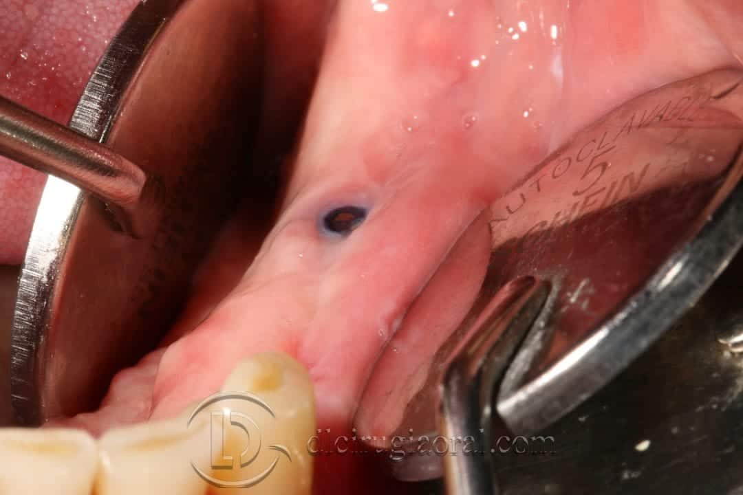 Vestibuloplastia de Kazanjian