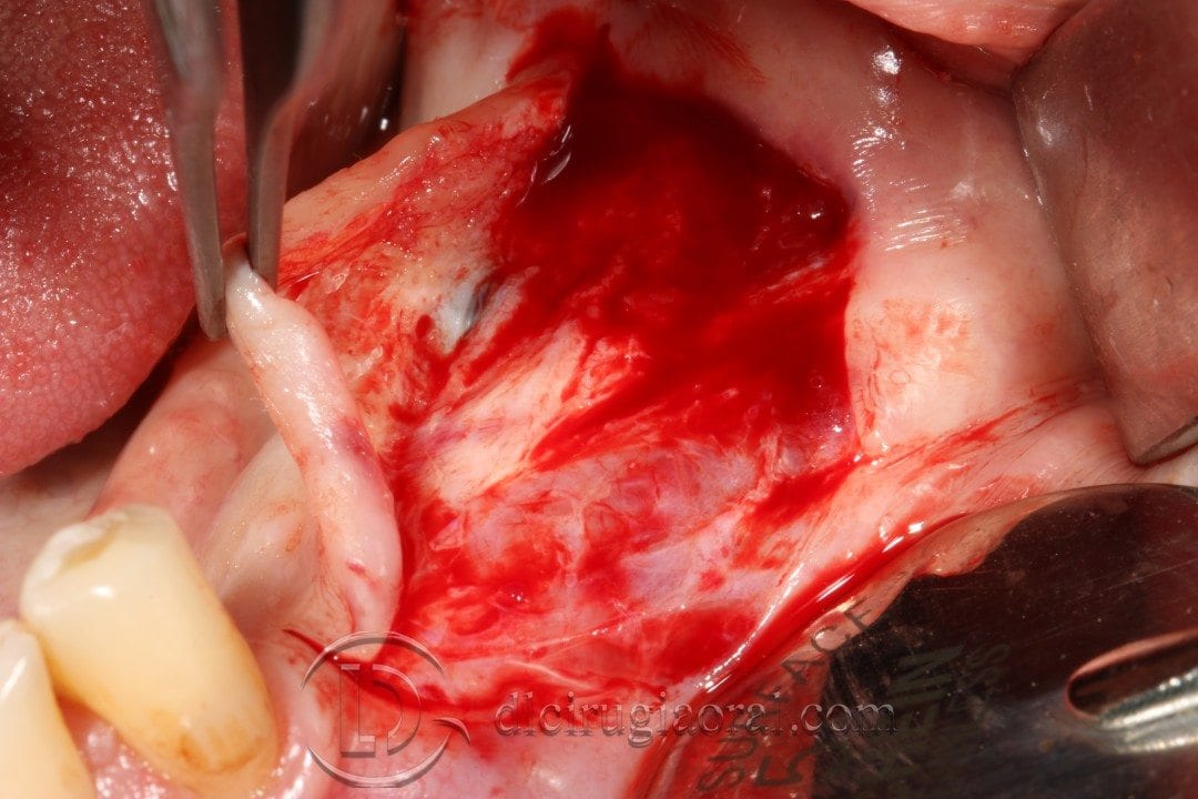 Vestibuloplastia de Kazanjian